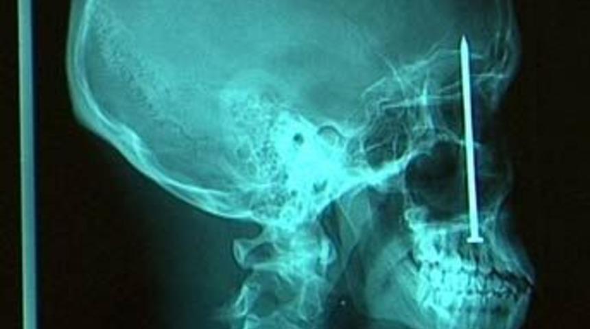 Hayrete d&uuml;ş&uuml;ren r&ouml;ntgen filmleri