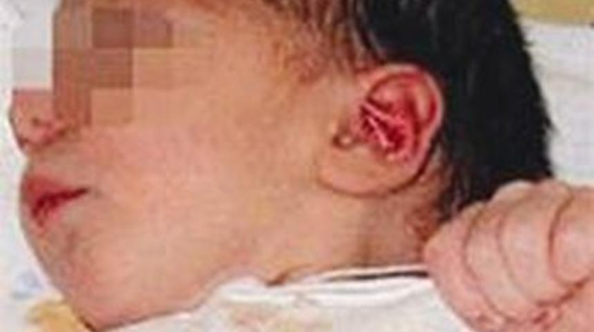 &Ccedil;ift penisle doğdu