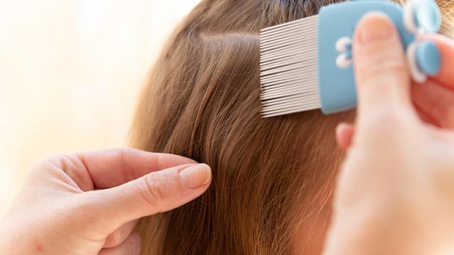 Saçtan bit ve sirke nasıl temizlenir? Saçta bit ve sikre neden olur?