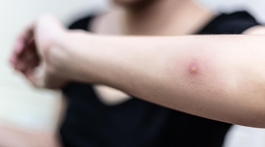 Çıbana ne iyi gelir? Çıbanın içi nasıl boşaltılır?