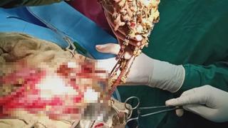Doktorları bile şaşkına çevirdi! Midesinden mücevher ve madeni para çıktı... Değeri dudak uçuklattı