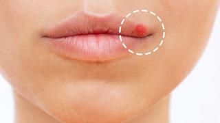 Dudak kenarında yara nasıl olur? Dudak kenarında yara için bitkisel çözümler