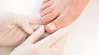 Ayak tırnak şekil bozukluğu nasıl düzelir? Tırnaklardaki şekil bozukluğu nasıl giderilir?