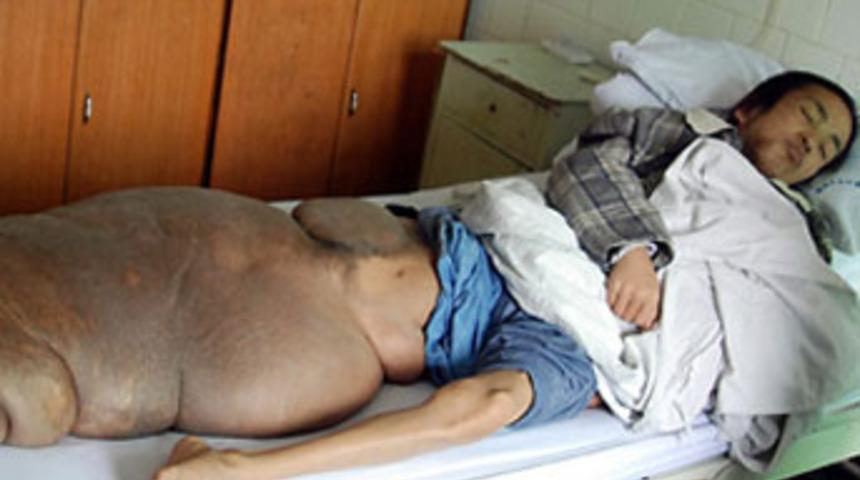 27 senedir bu bacakla yaşıyor