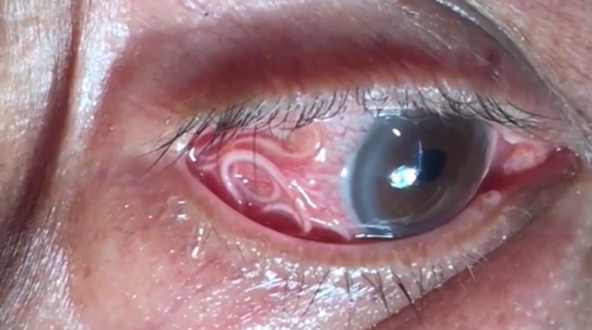 Doktorları bile şaşkına çeviren vaka! Gözünden 15 cm uzunluğunda canlı solucan çıkartıldı