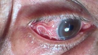 Doktorları bile şaşkına çeviren vaka! Gözünden 15 cm uzunluğunda canlı solucan çıkartıldı