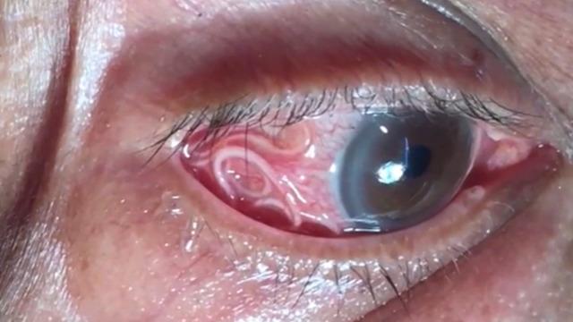 Doktorları bile şaşkına çeviren vaka! Gözünden 15 cm uzunluğunda canlı solucan çıkartıldı