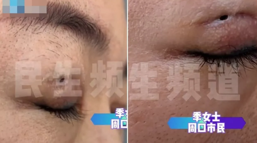 Estetik operasyon kabusu oldu! Güzelleşmek isterken gözünün ortasında kocaman bir delikle kaldı... “Gözyaşlarım dışarı çıkıyor”