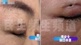 Estetik operasyon kabusu oldu! Güzelleşmek isterken gözünün ortasında kocaman bir delikle kaldı... “Gözyaşlarım dışarı çıkıyor”