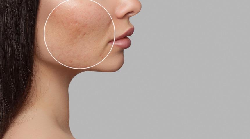 Yüzdeki delikler nasıl geçer? Yüzdeki delikler için doğal maske ve krem önerileri