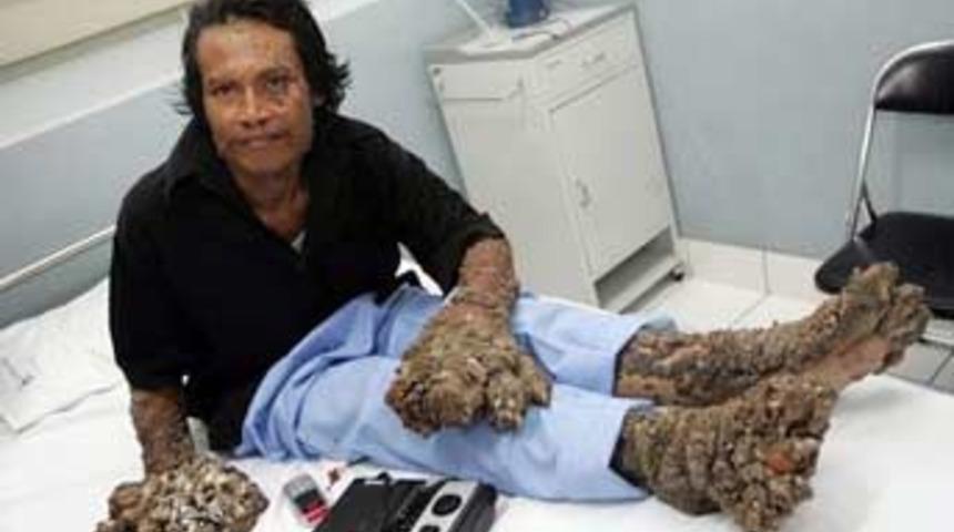 İşte dünyanın en garip hastalığı