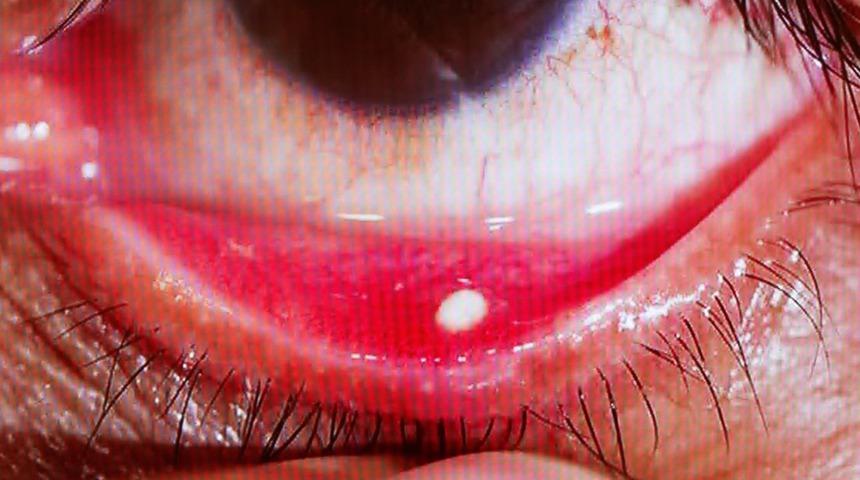 Gözünüzde bu görüntü varsa dikkat! Hemen hekime başvurun...