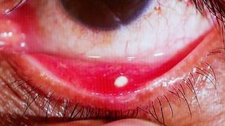 Gözünüzde bu görüntü varsa dikkat! Hemen hekime başvurun...