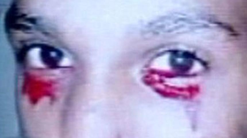 15 yaşındaki gen&ccedil; kan ağlıyor