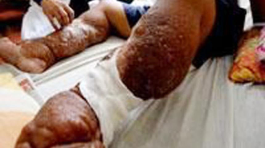 Bir sivrisinek ısırdı bu hale geldi