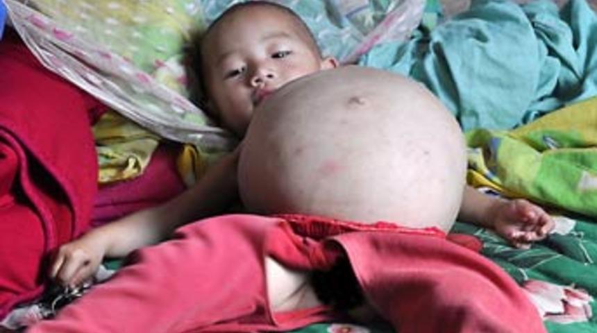 İkizini karnında taşıyor!