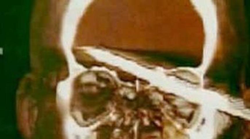 15 cm.lik zıpkın beyninde