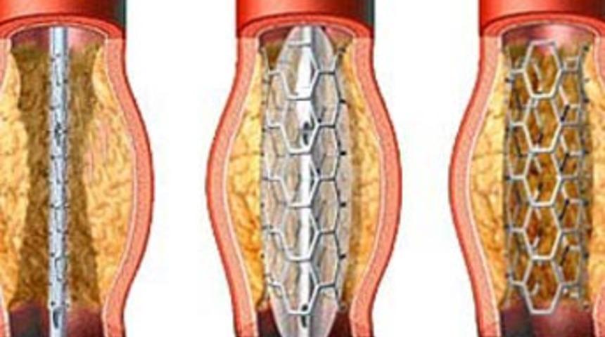 ''V&uuml;cutta emilebilen stentler'' kullanıma hazır