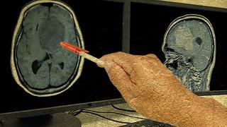 Uzun yıllardır konuşamayan felçli kadın, tekrar 'konuşabilir' oldu... Hem de sadece düşünerek!