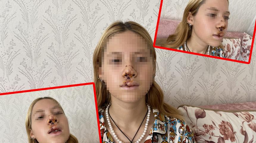 Türkiye onu konuşmuştu! Yüzüne kaldırım taşı atılan genç kızın yürek yakan feryadı: "Hayatım karardı, yüzüm değişti..."