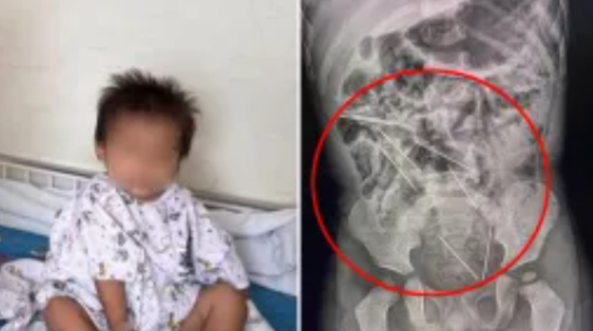 İki yaşındaki çocuk yanlışlıkla 8 tane dikiş iğnesi yuttu! Doktoları bile şaşkına çevirdi... "İşime odaklandığım için fark ettim"