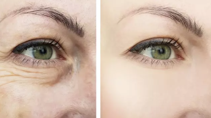 Ciltteki kırışıklıkları yok ediyor! Botoks etkisi gösteriyor