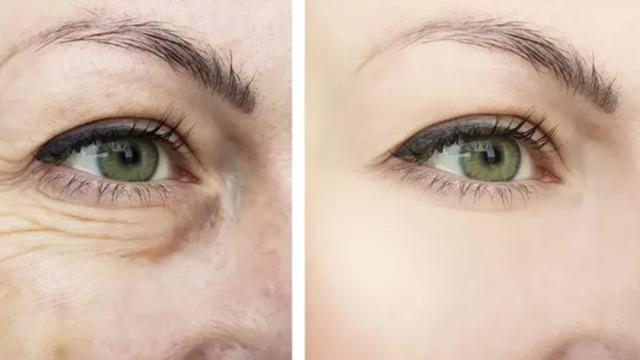 Ciltteki kırışıklıkları yok ediyor! Botoks etkisi gösteriyor