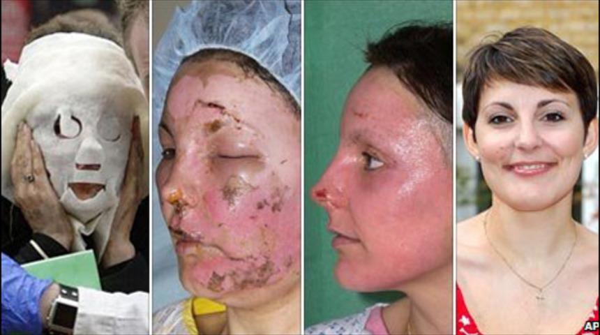 7 Temmuz saldırılarında y&uuml;z&uuml; yanan kadın iyileşti