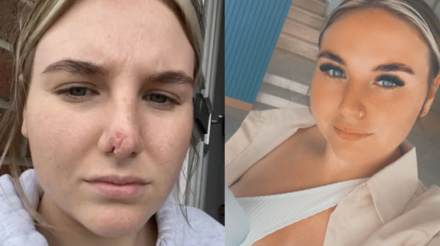 Köpeği sevmek için yanına yaklaştı! Aniden burnunu koparttı... "Burnumdan bir parça kopuyordu"