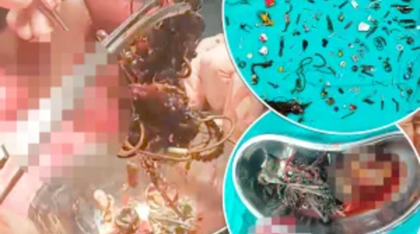 Mide ağrısıyla hastaneye giden adamın midesinden 60 adet ev eşyası çıkarttılar! Doktorlar bile şaşkına döndü
