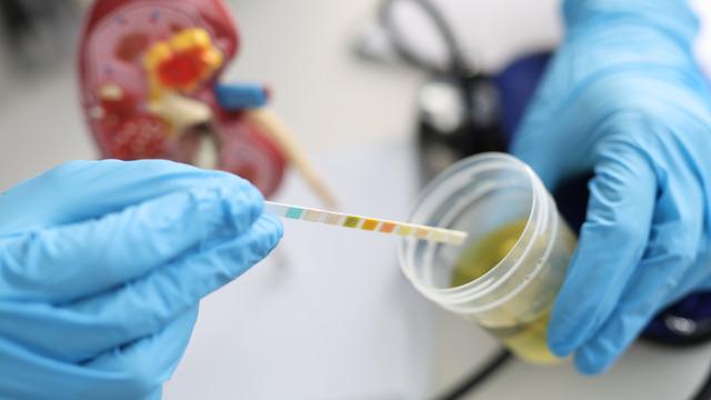 Ürik asit düşüklüğü tehlikeli mi? Ürik asit düşüklüğü neden olur?