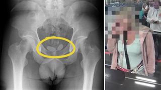 Röntgende ortaya çıktı! Uyuşturucuyu prezervatiflerin içine koyup cinsel organına gizlemiş
