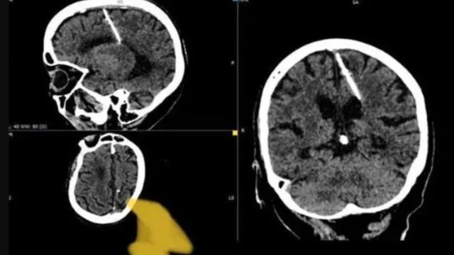 80 yaşındaki kadın tüm hayatı boyunca beyninde bulunan iğneyle yaşadı! Nedeni doktorları bile şaşkına çevirdi