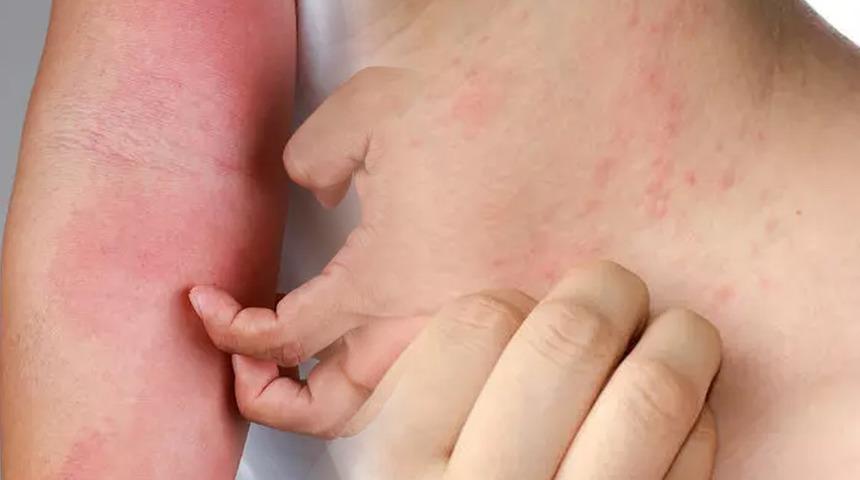 Vakalar her geçen gün katlanarak artıyor! Uzmanlar uyardı, 15 dakika bile yeterli: Bu belirtiler varsa...