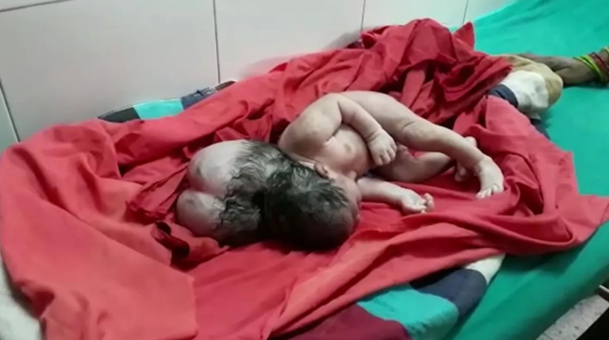 &Uuml;&ccedil; başlı doğan kız &ccedil;ocuğunun gizemli durumu doktorları bile şaşkına &ccedil;evirdi! Herkes onu g&ouml;rmek i&ccedil;in sıraya girdi