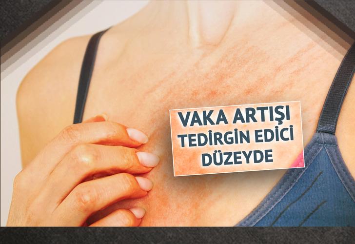 Türkiye'de salgın böyle yayılıyor! Vakalar patladı: