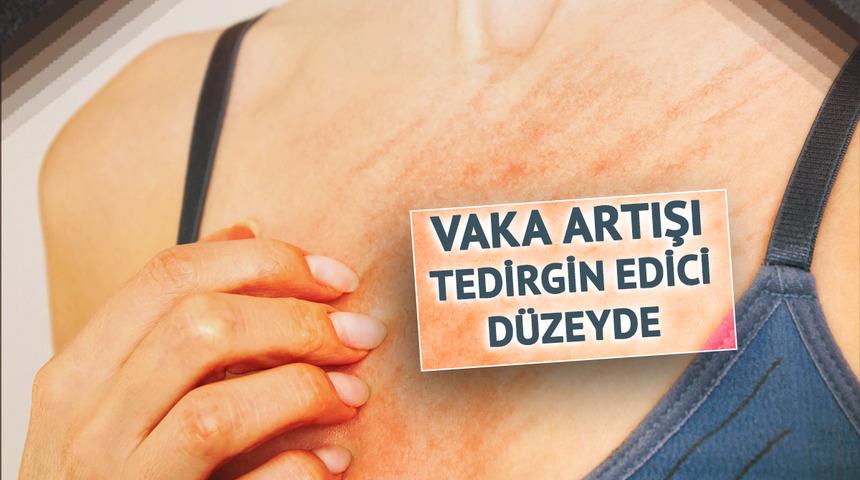 Türkiye'de salgın böyle yayılıyor! Vakalar patladı: "Utanıp söyleyemiyorlar, 5-6 ay kurtulamayan aileler var"