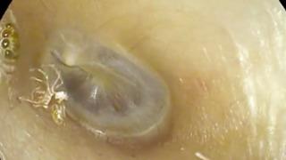 Anormal sesler duyduğu için doktora giden kadının kulağından örümcek çıktı! Doktorları bile şaşkına çevirdi