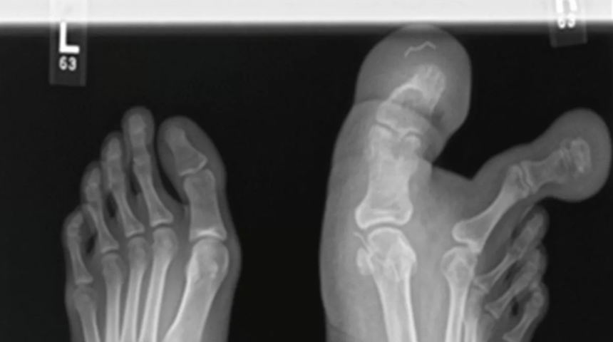 Son derece nadir görülüyor! İki ayak baş parmağı olan 12 yaşındaki kız yürümekte dahi zorlanıyordu... Ayakkabı bile giyemiyordu