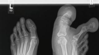 Son derece nadir görülüyor! İki ayak baş parmağı olan 12 yaşındaki kız yürümekte dahi zorlanıyordu... Ayakkabı bile giyemiyordu