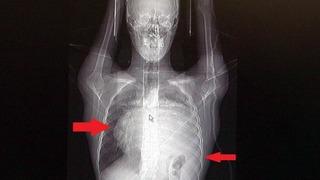 Doktorları bile şaşırttı! Kalbini 12 santimetre kaydırdı, akciğerini kağıt gibi ezdi