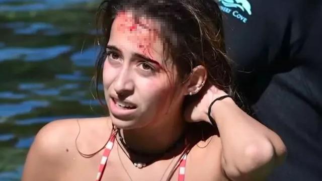 3 metrelik timsah saldırısından mucizevi şekilde kurtuldu! Kadını başından ısırdı... Kafasını ağzının içinde gördüm