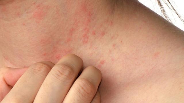 Çoğu hasta aylarca iyileşemiyor... Uzman isimden korkutan 'Uyuz' açıklaması! 'İlacı var ama SGK karşılamıyor'