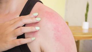 Yanığa ne iyi gelir? Yanık için evde ne yapmalı?