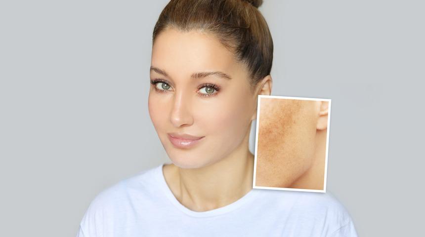 Ciltteki kahverengi lekeler nasıl yok edilir? Cilt lekelerine ne iyi gelir?