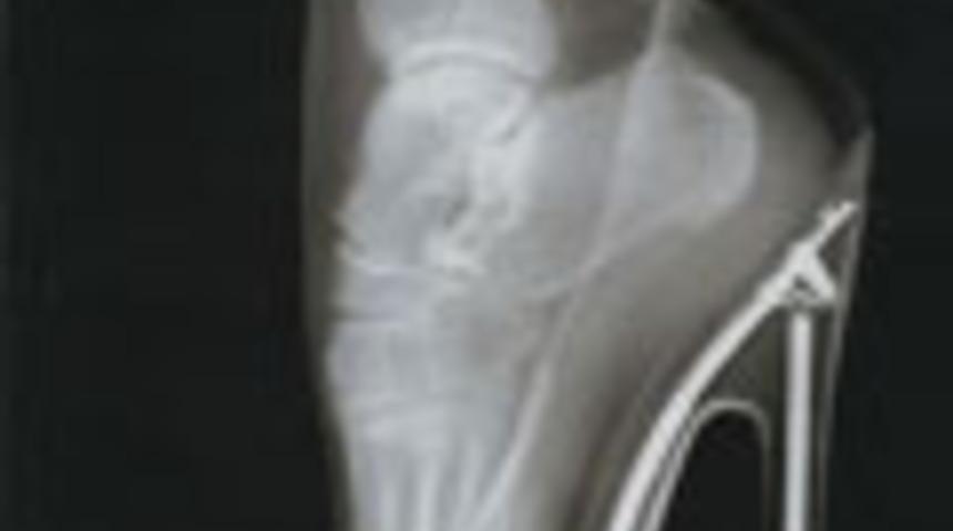 Seksi Topuktaki Tehlike