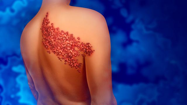 Zona nedir, neden olur? Zona hastalığının çaresi nedir?