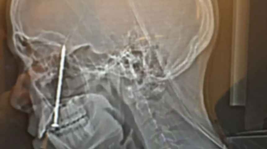 Korkunç kaza! Elektrikli çivi makinesi bir anda patladı... Diline ve kafatasına çiviler saplandı