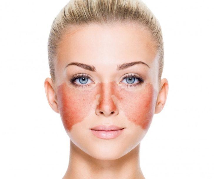 Yüzünüzdeki problemler iç sağlığınızı ele veriyor G5