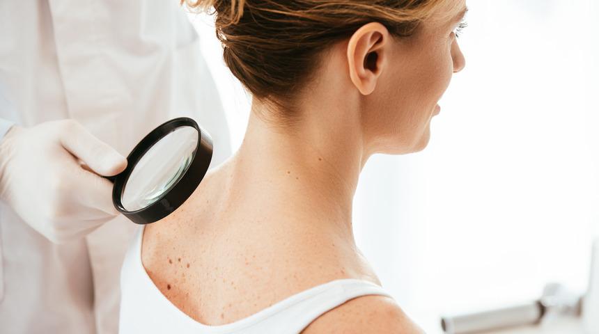 Cilt (Deri) kanseri nedir? Cilt kanseri olduğumu nasıl anlarım?